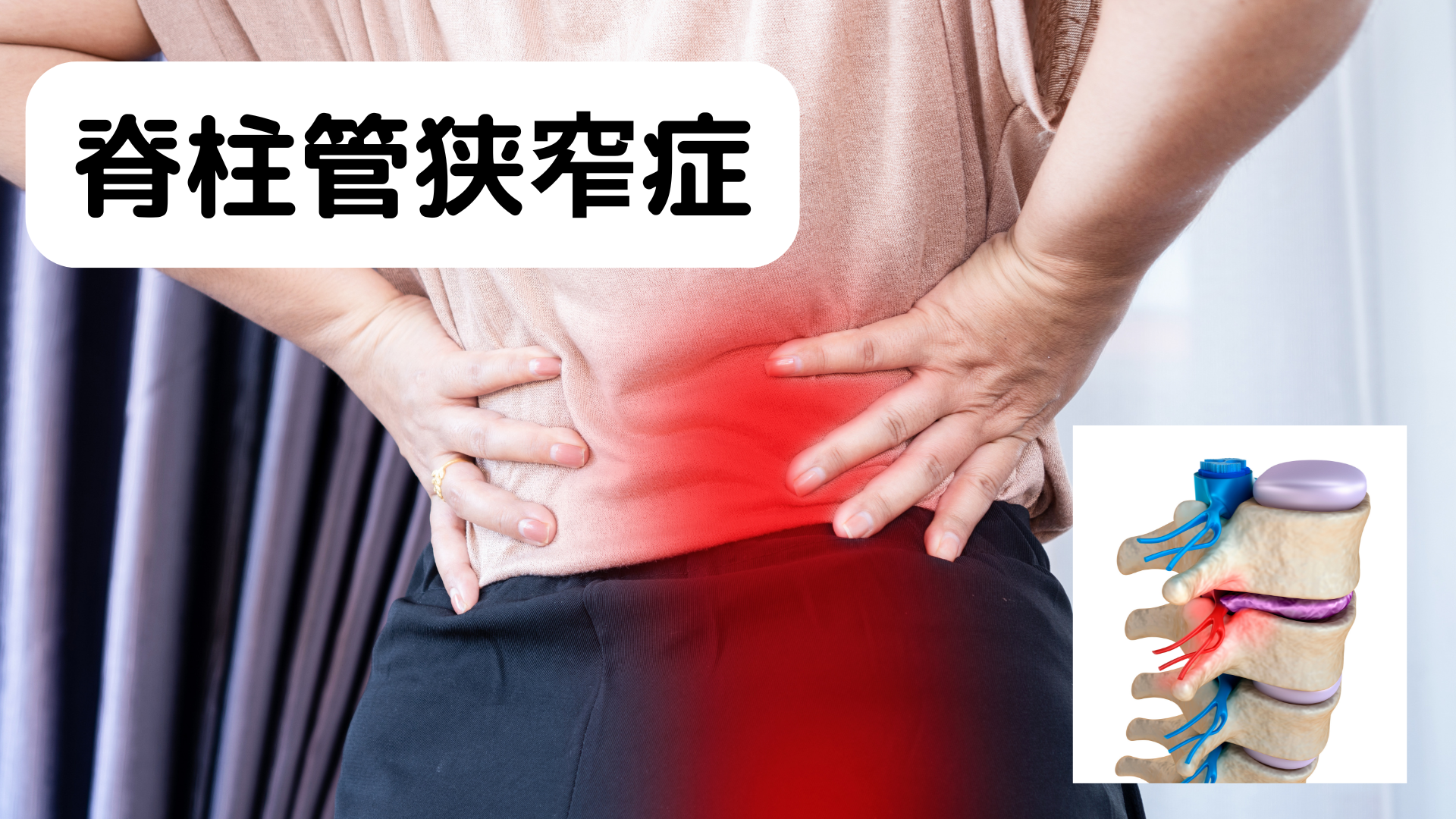 脊柱管狭窄症について